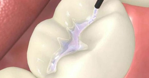 Pit And Fissure Sealants
